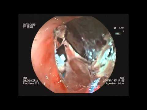Видео: Баллонная дилатация при рубцовой стриктуре колоректального анастамоза