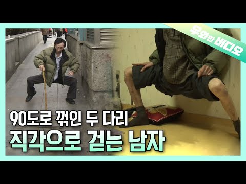 Видео: Человек, который всю жизнь прожил с негнущимися ногами под прямым углом