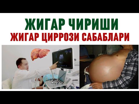 Видео: ЖИГАР ЧИРИШИ ЦИРРОЗ САБАБЛАРИ / БЕЛГИЛАРИ / ТАШХИС / ГЕПАТИТ В, С, АСОРАТИ ЭРТА ЎЛИМ ОМИЛИ