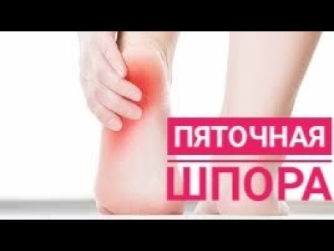 Видео: ПЯТОЧНАЯ ШПОРА. Как убрать боль и шип в пятке?