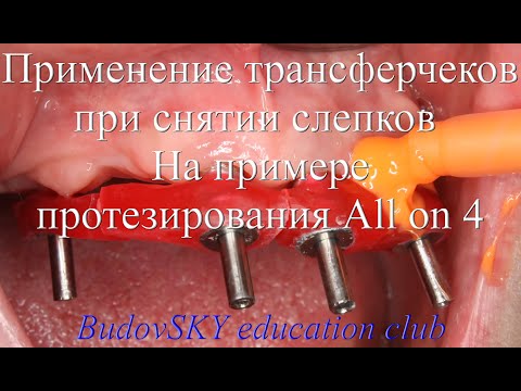 Видео: Снятие слепков с использованием трансферчеков. На примере протезирования All on 4
