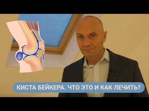 Видео: КИСТА БЕЙКЕРА. ЧТО ЭТО И КАК ЕЁ ЛЕЧИТЬ?