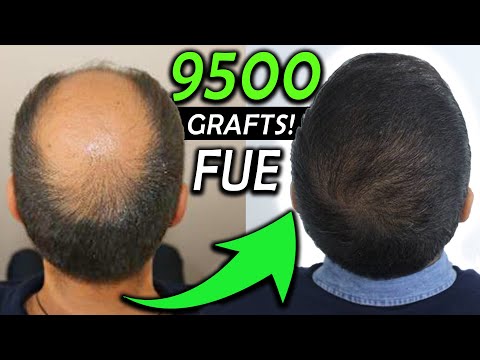 Видео: Трансплантация волос Kay's 9500 Graft FUE!!! NW 6