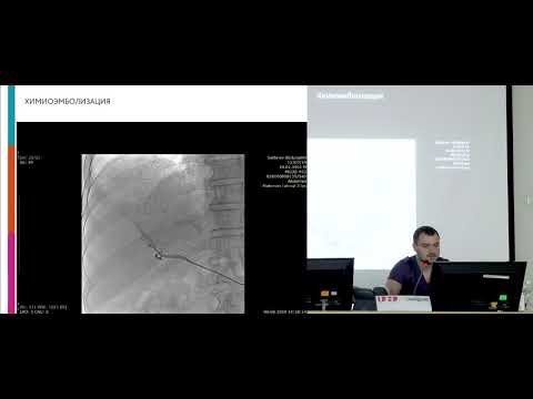 Видео: Лившиц М. В. Интервенционная радиология в онкологии