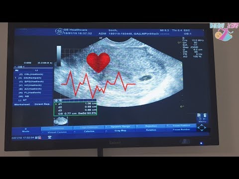 Видео: Моя первая беременность после ЭКО, но нет сердцебиения....