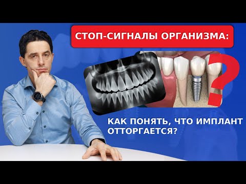 Видео: Топ-7 главных вопросов о приживлении имплантов