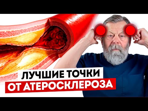Видео: 5 точек от АТЕРОСКЛЕРОЗА