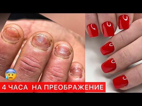 Видео: ЗАРОСШАЯ КУТИКУЛА И НАРАЩИВАНИЕ ГРЫЗУНЧИКУ😰СЛОЖНЫЙ МАНИКЮР