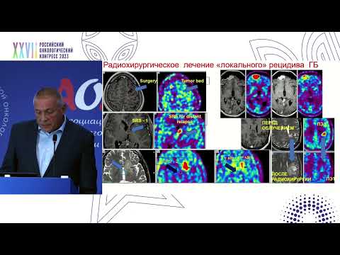 Видео: Возможности радиохирургии в лечении злокачественных глиом