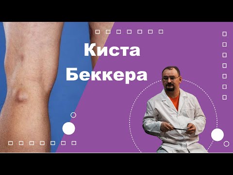Видео: Киста Беккера в коленном суставе
