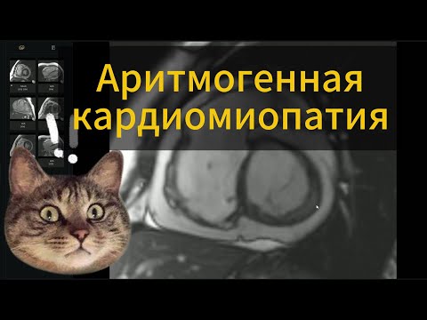 Видео: Аритмогенная кардиомиопатия