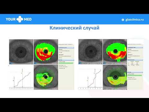 Видео: 8. "Синдром сухого глаза в практике катарактального хирурга". Майчук Н. В., Москва