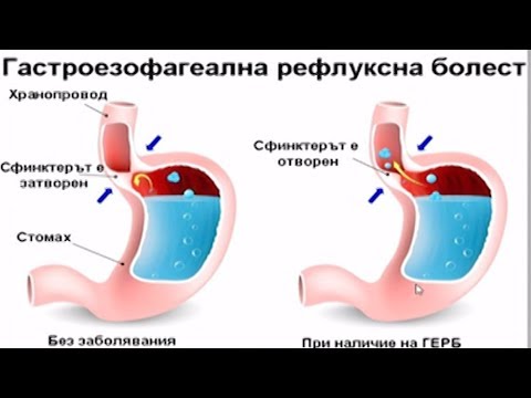 Видео: Рефлуксна болест и езофагит - причини, клиника и лечение