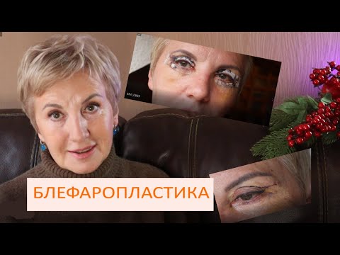 Видео: БЛЕФАРОПЛАСТИКА ДО И ПОСЛЕ