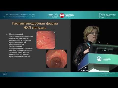 Видео: Лимфомы желудка
