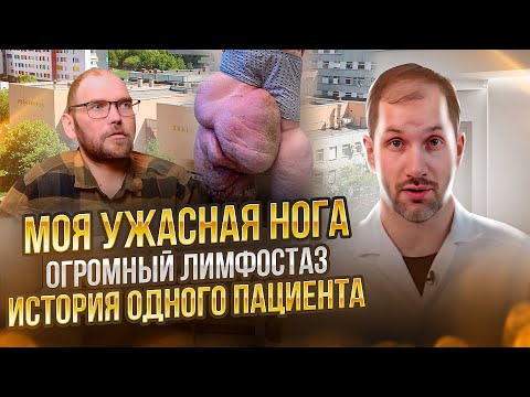 Видео: МОЯ УЖАСНАЯ НОГА: огромный лимфостаз (слоновость) - история одного пациента