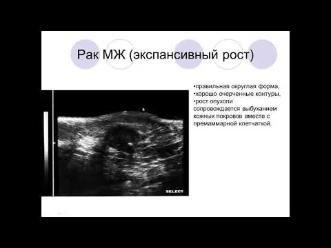 Видео: Рак молочной железы