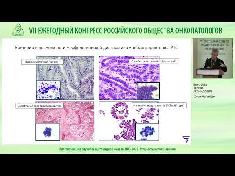 Видео: Классификация опухолей щитовидной железы ВОЗ 2022  Трудности интерпретации