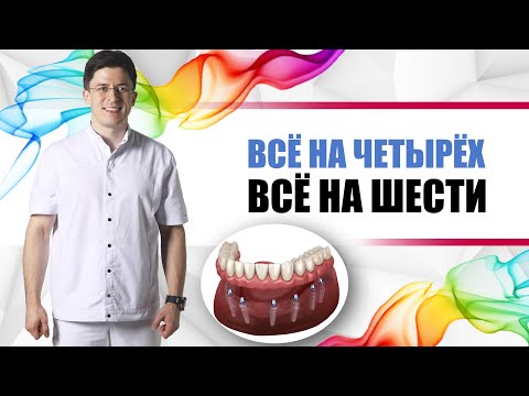Видео: All-on-four / All-on-six [ Всё на четырёх, Всё на шести ]. Зубы за один день на 4 или 6 имплантах.