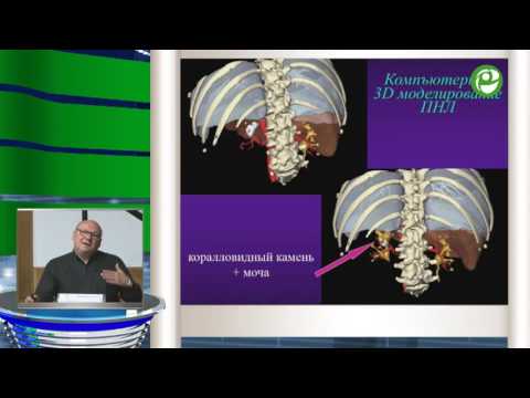 Видео: Мартов А Г - Перкутанное лечение коралловидного нефролитиаза