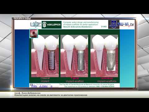 Видео: Компютърен анализ на скеле за импланти за дентално приложение