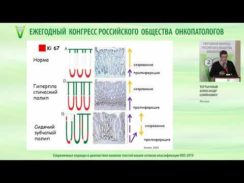 Видео: Современные подходы в диагностике полипов толстой кишки согласно классификации ВОЗ-2019