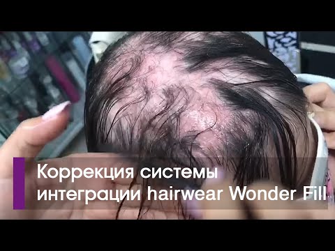 Видео: Новые волосы без сбривания оставшихся, быстрое решение при женской алопеции. Носить можно годами.