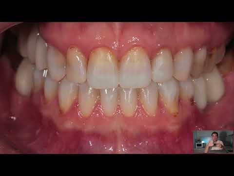 Видео: MockUp/Мокап. Фрагмент курса про виниры