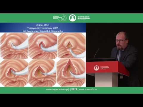 Видео: Особенности ЭПСТ при интрадивертикулярной локализации Фатерова сосочка