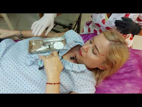 Видео: ВЛ канюля. Височная область(фрагмент).
