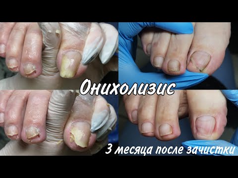Видео: Лечение, зачистка, онихолизиса, отслоение ногтей,  аппаратный педикюр и обработка. Возрастные ноги