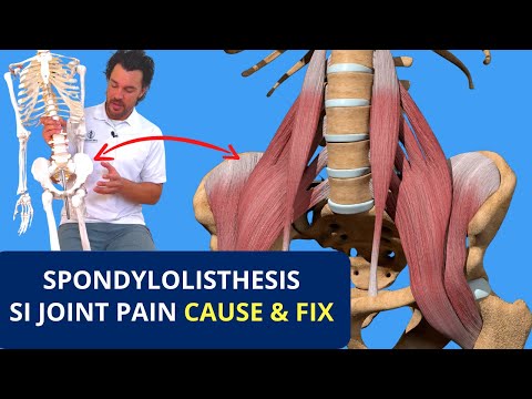 Видео: Боль в спондилите и крестцово-подвздошном суставе вызвана напряжением сгибателей бедра 🦵🏼