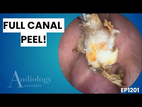 Видео: Аудиолог снимает полный слепок кожи слухового прохода | Эндоскопическое видео - EP1201