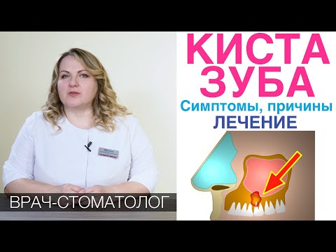 Видео: Киста зуба - как лечить. Симптомы и диагностика кисты зуба.Методики лечения кисты зуба - цистэктомия