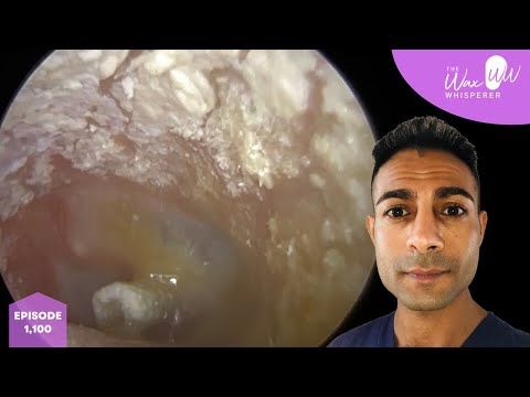 Видео: 1100 — Сильно зудящая, шелушащаяся, омертвевшая кожа в ухе с вентиляционной трубкой