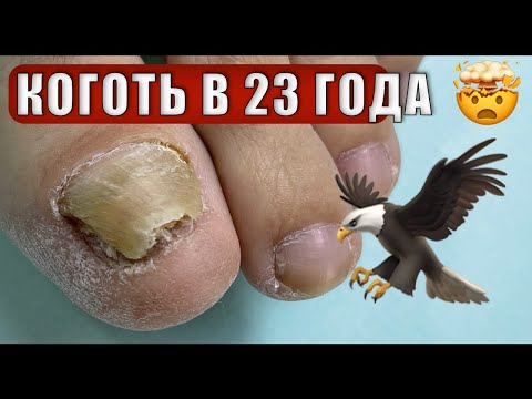 Видео: Вырезать😨, действительно ли это поможет? Онихогрифоз