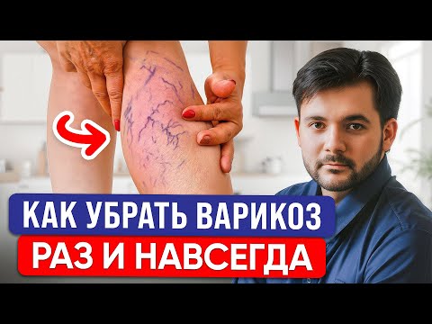 Видео: Это СПАСЕТ Вас От ВАРИКОЗА! Самые ПРОСТЫЕ Способы УБРАТЬ Варикоз в Домашних Условиях!