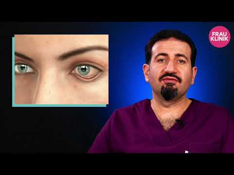 Видео: Осложнения после блефаропластики