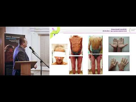 Видео: Коломейцев О. А. Разбор клинических случаев кожных Т-клеточных лимфом.