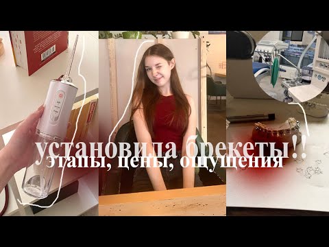 Видео: установила брекеты: этапы, цены, первые ощущения | распаковка с вб и озона