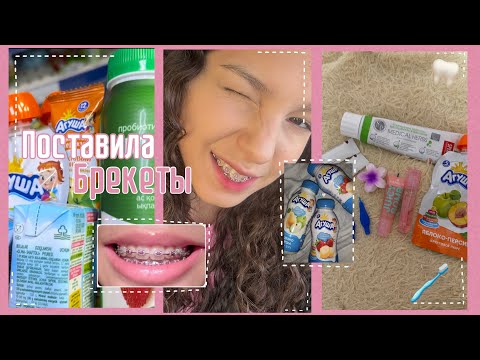 Видео: Влог:поставила брекеты🦷✨установка брекетов💥моя жизнь с брекетами ❤️
