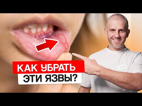 Видео: Что делать с ЯЗВАМИ во рту? Легкий СПОСОБ убрать и снять боль