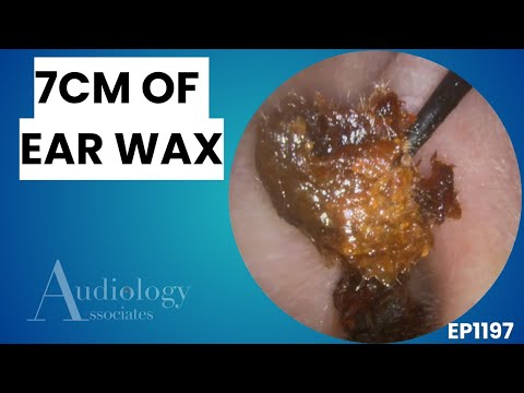 Видео: Невероятная чистка ушей — удаление огромной затвердевшей серной пробки — EP1197