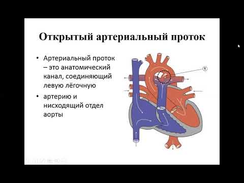 Видео: ЭхоКГ диагностика ОАП