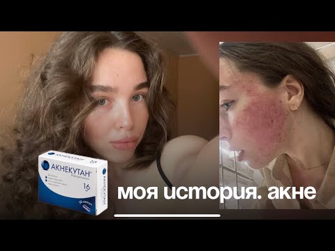 Видео: МОЯ ИСТОРИЯ АКНЕ. АКНЕКУТАН. ЦЕНЫ