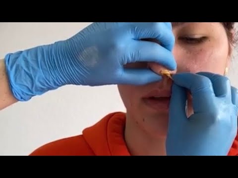 Видео: Депиляция воском: "НОС"