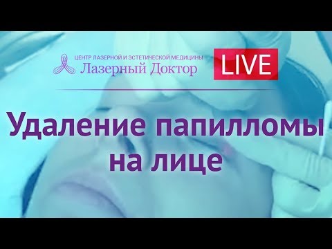 Видео: Лазерное удаление папиллом на веках - Periscope