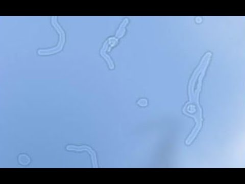 Видео: "Мушки перед глазами", или деструкции стекловидного тела - ОТКУДА ОНИ и ЧТО ДЕЛАТЬ?