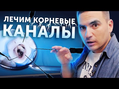Видео: Лечение корневых каналов зуба | Процедура под микроскопом