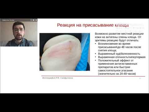 Видео: Клещевые инфекции. Цикл семинаров. Доклад Р.Ф. Сайфуллина